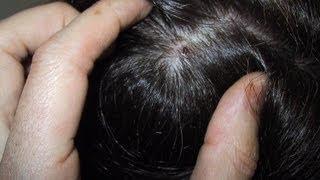 How to Treat a Dry Scalp DermTV.com Epi #482