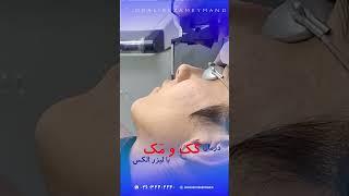 درمان کک و مک با لیزر الکس #beauty #laser #کک_مک متخصص پوست کرج