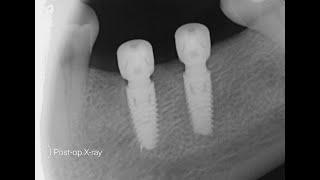 MIS C1 Guided Implant Placement  Ø4.20x10mm  Mandible Jaw