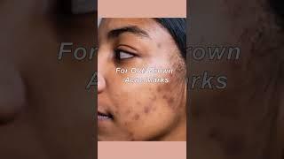 Pharmacy creams for acne marks more details on  description box  #facedecor #skincare #shorts