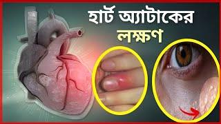 এক মাস আগে থেকেই দেখা যায় হার্ট অ্যাটাকের লক্ষণ  Sign Of health attack & Treatments