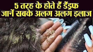 डैंड्रफ से निजात दिलाएंगे ये उपाय  Dandruff special remedy  Dandruff types remedy  Boldsky