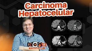 CARCINOMA HEPATOCELULAR CHC I VOCÊ RADIOLOGISTA