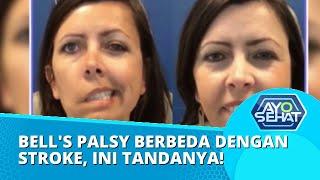 Faktor Penyebab Bells Palsy Hingga Perbedaannya dengan Stroke  AYO SEHAT