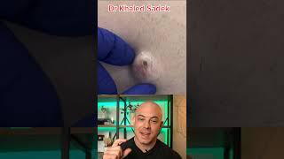 Doctor reacts to MASSIVE cyst #dermreacts #doctorreacts #pimplepop #cystpop