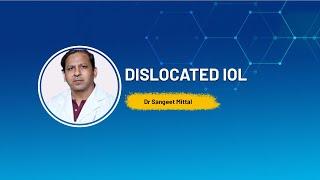 Dislocated IOL Dr. Sangeet Mittal