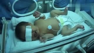 Poor newborn baby with jaundice is very painful when exposed to blue light