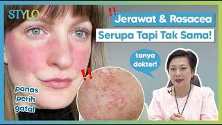 Mirip Jerawat Ini Gejala Rosacea yang Sering Diabaikan oleh Banyak Orang Menurut Pakar  Stylo