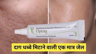 त्त्वचा पर से दाग धब्बे मिटाने वाली 1 मात्र असरदार जेल - Opexa Gel Advanced Scar Treatment Review