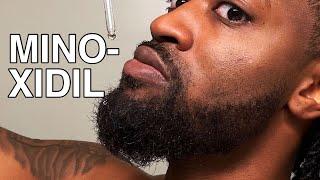 Why I Stopped Using Minoxidil  Does Minoxidil Actually Work?