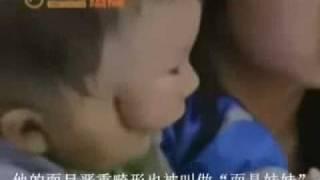 The Two-Faced Baby Boy from China The Mask-Face Baby