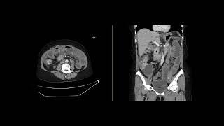 Small bowel obstruction