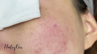 Halo Skin Hong Kong 暗粒療程 Acne and Blackheads around the mouth #Shorts