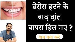 Relapse after braces  ब्रेसेस हटने के हिलने लगे  Best braces treatment in Indore