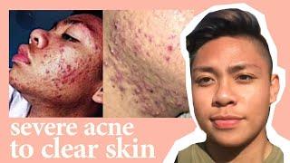 Acne ruined my life  real tips + story time