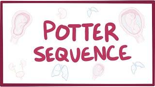 Potter sequence oligohydramnios - causes symptoms diagnosis treatment pathology