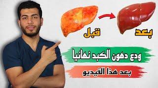 اسهل طريقه لازالة دهون الكبد وعلاج تشحم الكبد فى المنزل دهون الكبد اعراضها وعلاجها ومدى خطورتها