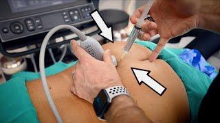 DOCTOR USES ULTRASOUND TO GUIDE HUGE NEEDLES INTO INFLAMEDNERVES Very Painful  Dr. Paul