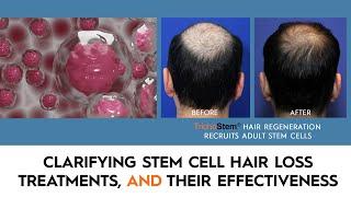 What You Need to Know About Stem Cell Hair Restoration and the Treatments that Work
