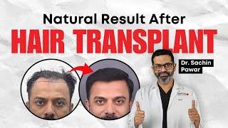 Natural Result after Hair Transplant  Dr. Sachin Pawar  HairMD Pune