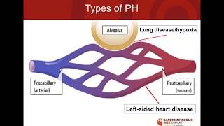 Pulmonary Arterial Hypertension Advancing Diagnosis and Management