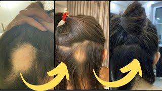 Hair Growth Oil  Fast Hair Growth  Effective Baldness Repair  Hereditary Hair Loss 