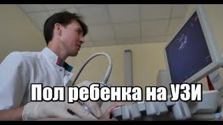 Пол ребенка на УЗИ в 13 недель. Рассказывает врач УЗД ЦИР А.А. Бикбулатов