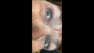 Triple Canal Positional Vertigo Eye Movement Video Findings