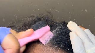 Extreme Dandruff Scratching  Tons of Endless Dry Itchy Flakes Falling  Fall Scalp Relief