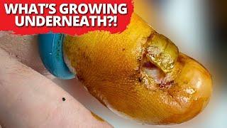 What’s Growing Under This Nail?? You Won’t Believe This