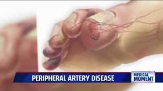 Symptoms and Treatments for Peripheral Artery Disease PAD