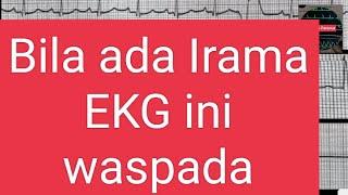 SERI PEMBELAJARAN PERAWAT  GAMBARAN EKG Part 3 Ventrikuler Takikardi