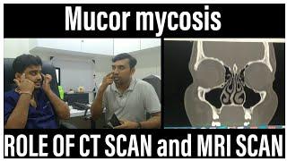 MUCORMYCOSIS Role Of CT SCAN  and MRI SCAN in Diagnosis