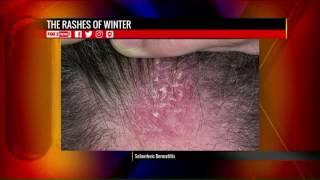 The Rashes of Winter