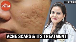 What are acne scars & why deeper treatment is required to lighten them