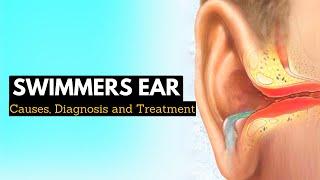 Say Goodbye to Swimmers Ear Effective Treatment Options