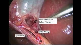 LIVE Gall Bladder Removal Surgery in Panchkula - Dr. Harsh Garg