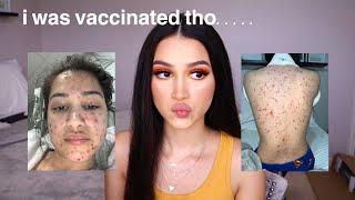 i got the chicken pox at 22 years old  storytime *with pictures*