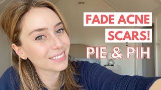 How To Fade Acne Scars Post Inflammatory Erythema & Post Inflammatory Hyperpigmentation