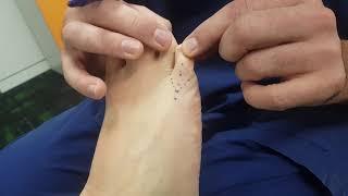 Surgical correction of an elevated fifth toe - Digiti Quinti Varus