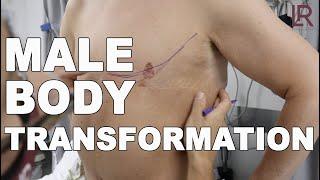 Male Body Transformation  Pec Implants Liposuction Renuvion Skin Tightening Scar Revision