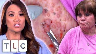 Dr. Lee Removes As Many Bumps As Possible From A Womans Face  Dr. Pimple Popper  UNCENSORED  18+