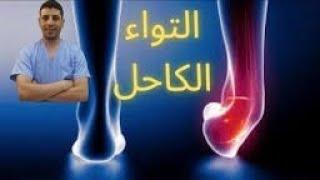 تمزق أربطة الكاحل التواء الكاحلجزع أربطة الكاحل #الكاحل #التواء_الكاحل #anklepain