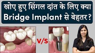 खोए हुए सिंगल दांत के लिए क्या बेहतर Bridge या Implant?  Dr. Vishakha Jain  Seraphic Dental Indore