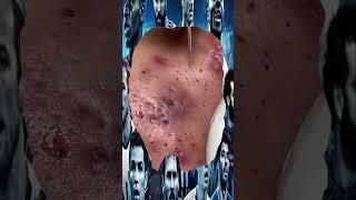 Blackheads Removal  Acne Treatment and Very Satisfying Satisfying Pimple pop #blackheads