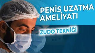 Penis Uzatma Ameliyatı  Zudo Tekniği