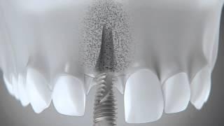 V3 Implant   Inmediate replacement of an upper central   Fla