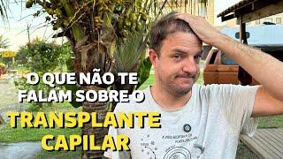 COMO ESTÁ MEU CABELO APÓS 1 ANO DE TRANSPLANTE CAPILAR