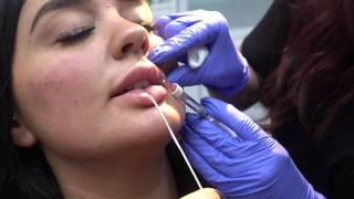 Keyhole Pout Lip Augmentation & Cheek Augmentation with Restylane and Radiesse