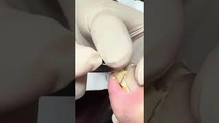 WHATS HIDING UNDERNEATH THIS NAIL?? SPED UP #nails #foot #impactedtoenail #nailcare #satisfying